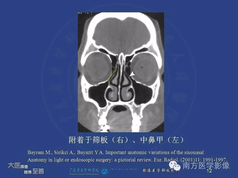 影像PPT - 【PPT】钩突（Uncinate process）解剖及变异-12