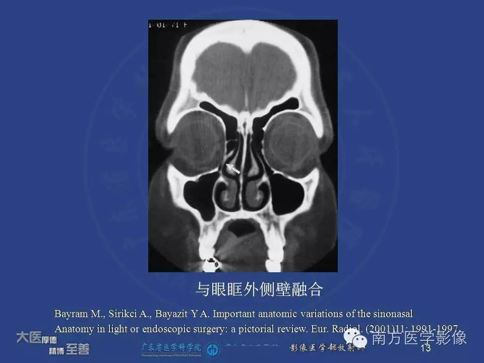 影像PPT - 【PPT】钩突（Uncinate process）解剖及变异-13