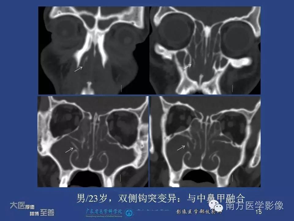 影像PPT - 【PPT】钩突（Uncinate process）解剖及变异-15