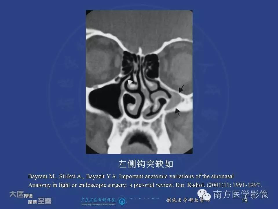 影像PPT - 【PPT】钩突（Uncinate process）解剖及变异-18