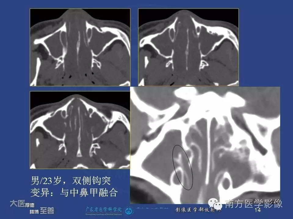 影像PPT - 【PPT】钩突（Uncinate process）解剖及变异-14
