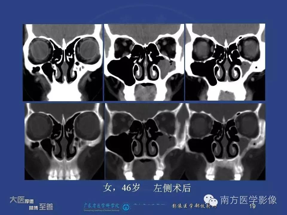 影像PPT - 【PPT】钩突（Uncinate process）解剖及变异-19