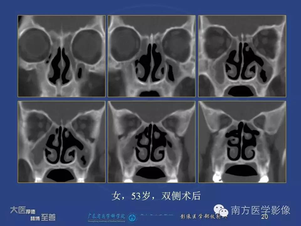 影像PPT - 【PPT】钩突（Uncinate process）解剖及变异-20