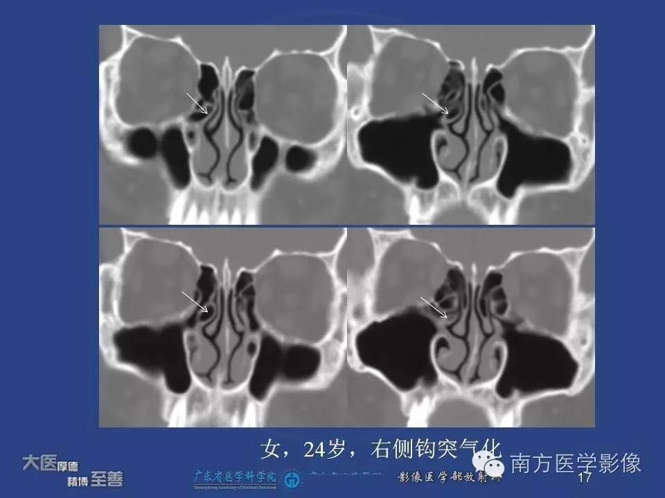 影像PPT - 【PPT】钩突（Uncinate process）解剖及变异-17