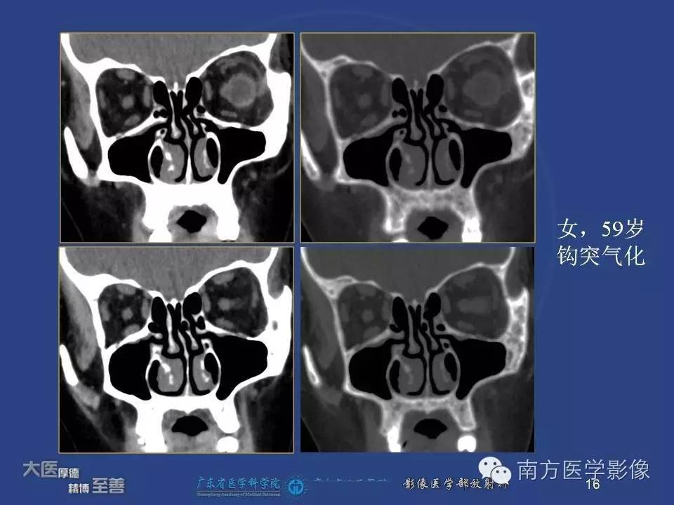 影像PPT - 【PPT】钩突（Uncinate process）解剖及变异-16