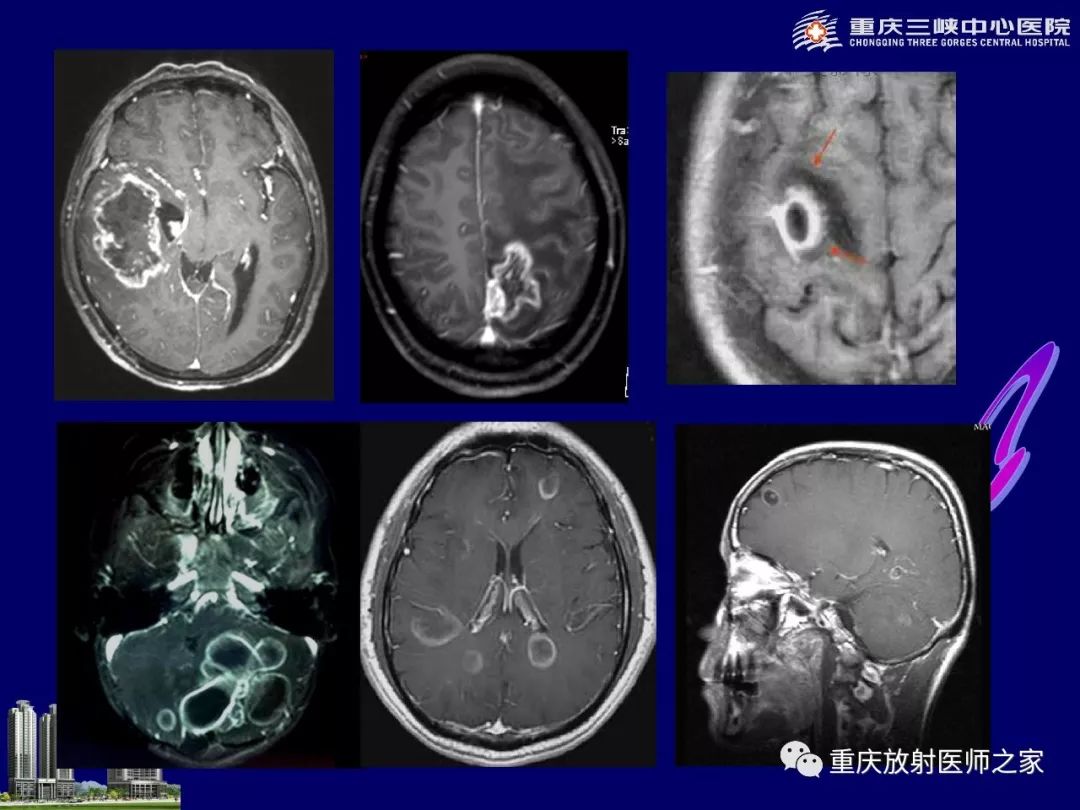 影像PPT - 【PPT】脑内环形强化病变的影像诊断思路-2