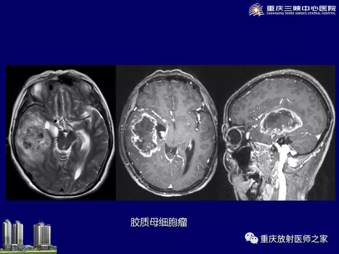 影像PPT - 【PPT】脑内环形强化病变的影像诊断思路-11
