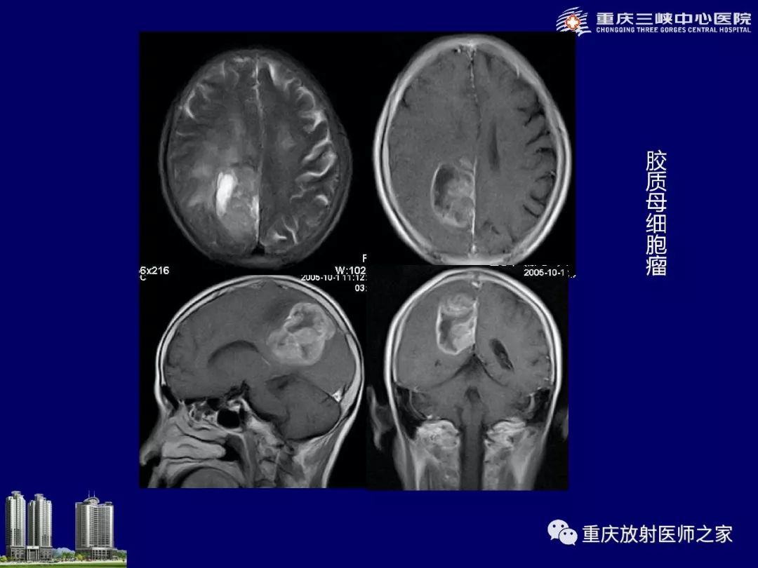 影像PPT - 【PPT】脑内环形强化病变的影像诊断思路-12