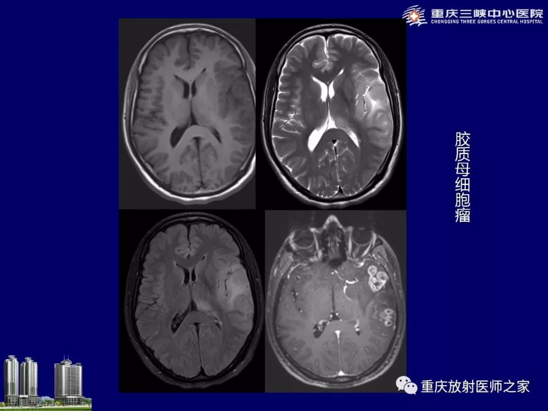 影像PPT - 【PPT】脑内环形强化病变的影像诊断思路-13