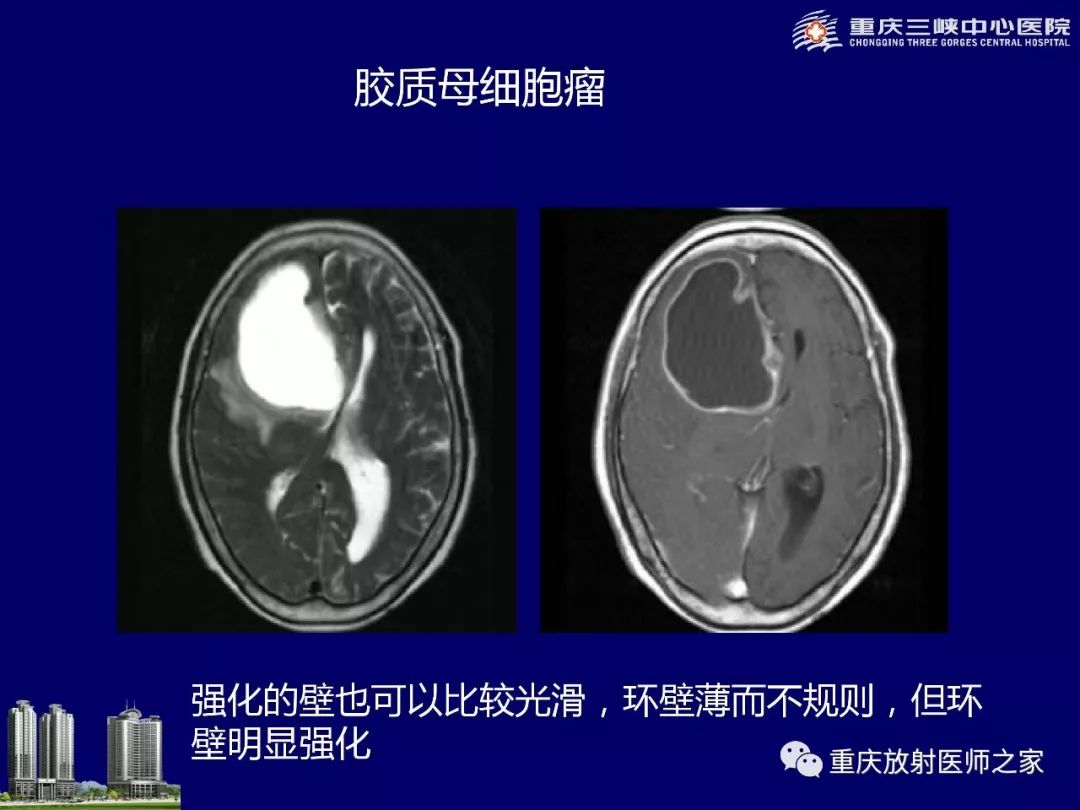 影像PPT - 【PPT】脑内环形强化病变的影像诊断思路-15