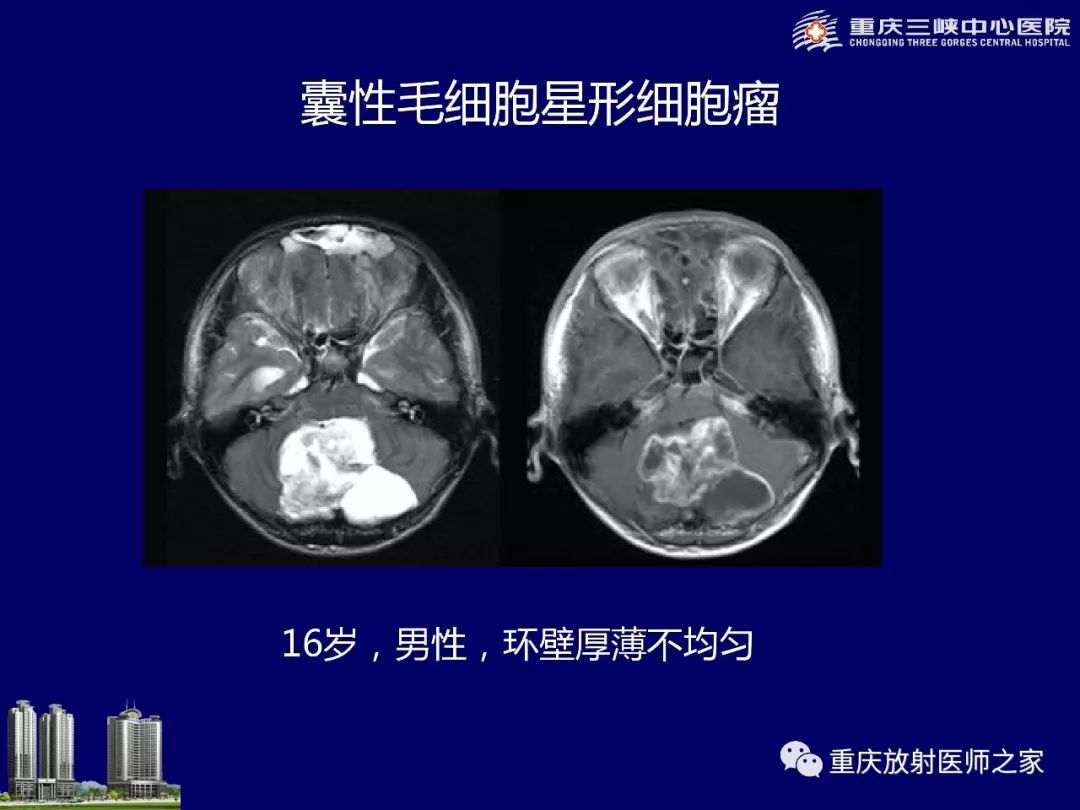 影像PPT - 【PPT】脑内环形强化病变的影像诊断思路-18