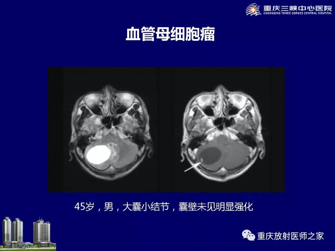 影像PPT - 【PPT】脑内环形强化病变的影像诊断思路-19