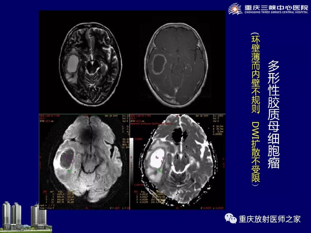 影像PPT - 【PPT】脑内环形强化病变的影像诊断思路-14
