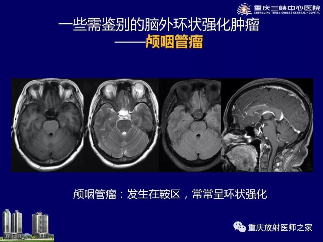 影像PPT - 【PPT】脑内环形强化病变的影像诊断思路-21