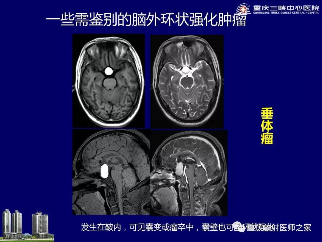 影像PPT - 【PPT】脑内环形强化病变的影像诊断思路-22