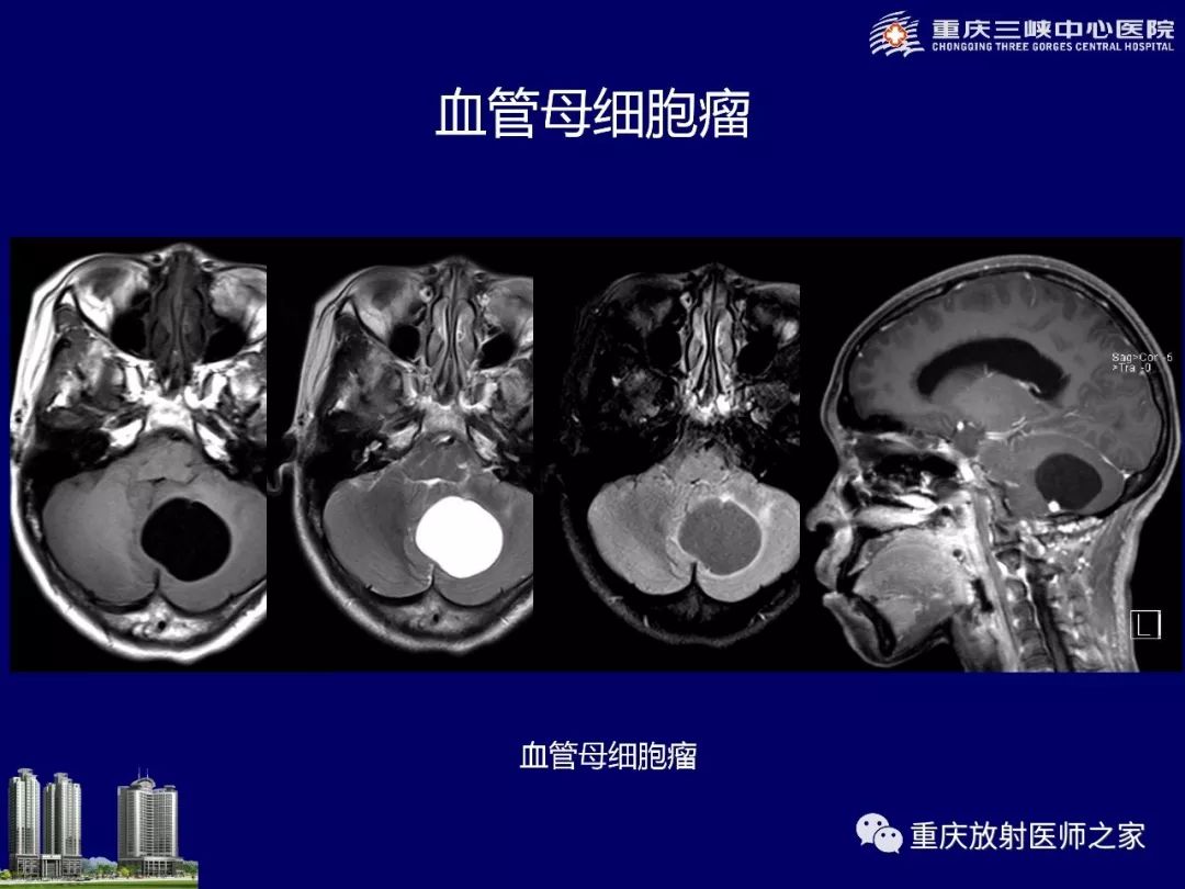 影像PPT - 【PPT】脑内环形强化病变的影像诊断思路-20