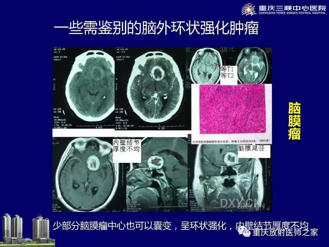 影像PPT - 【PPT】脑内环形强化病变的影像诊断思路-23