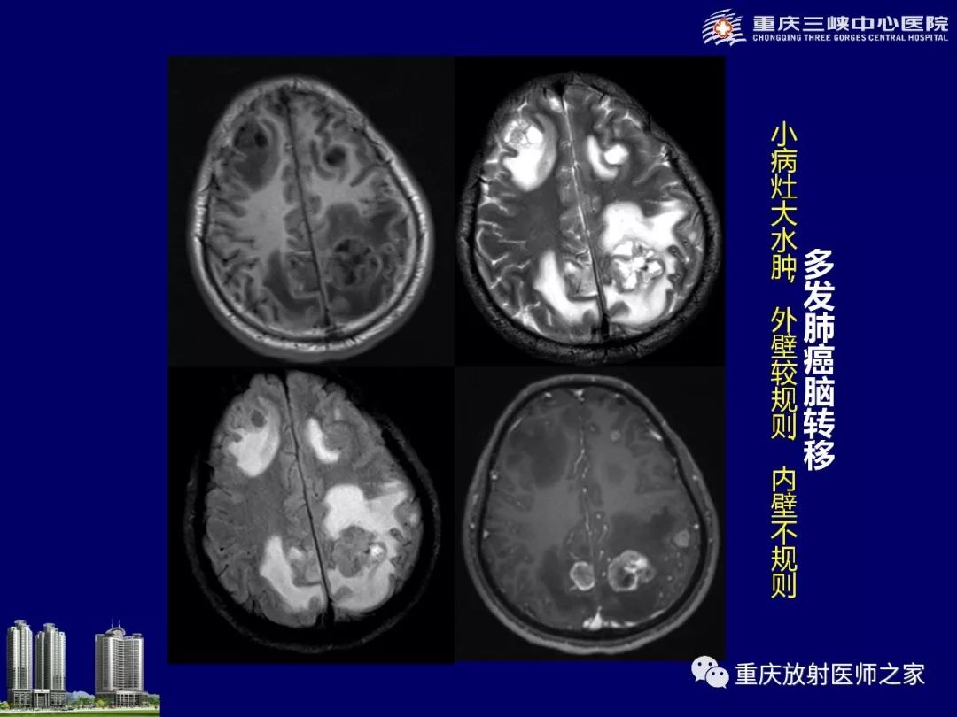 影像PPT - 【PPT】脑内环形强化病变的影像诊断思路-27
