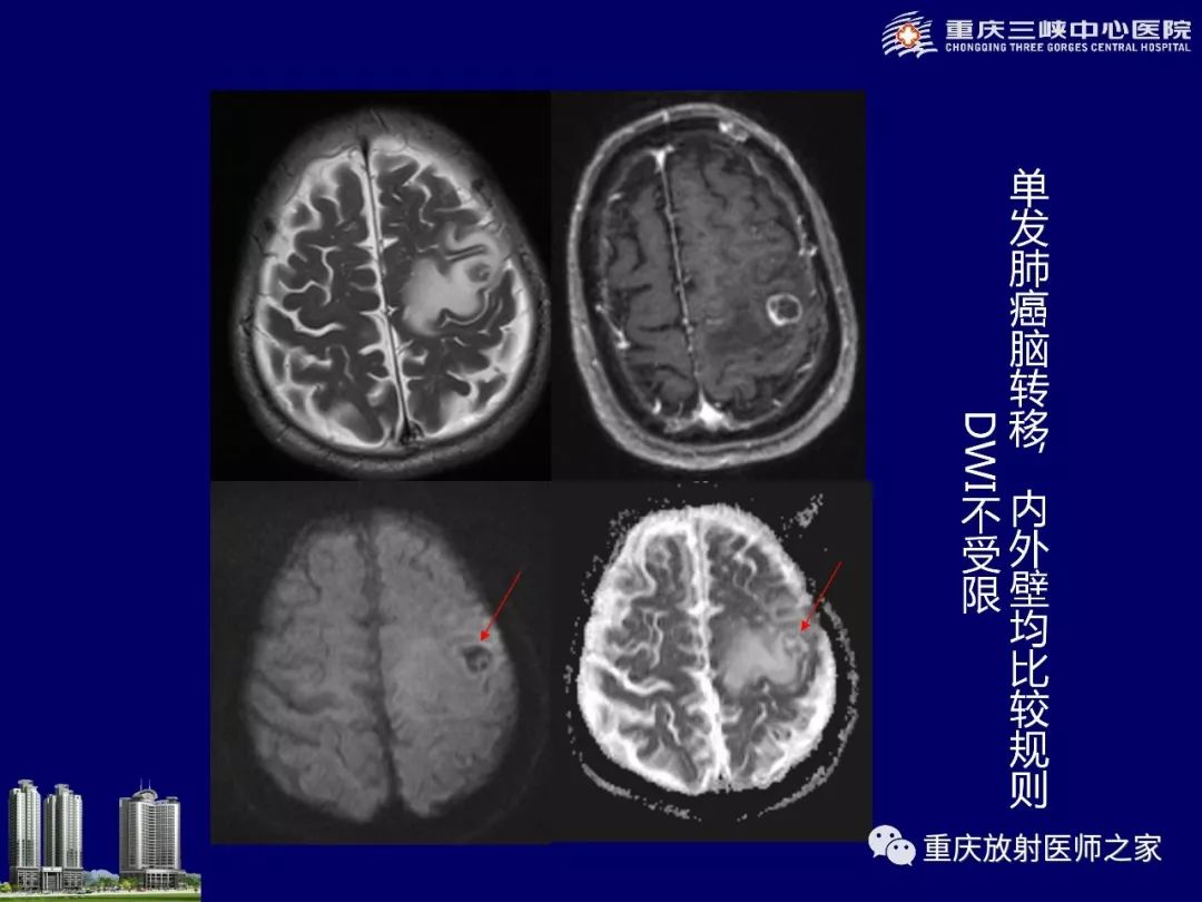 影像PPT - 【PPT】脑内环形强化病变的影像诊断思路-29