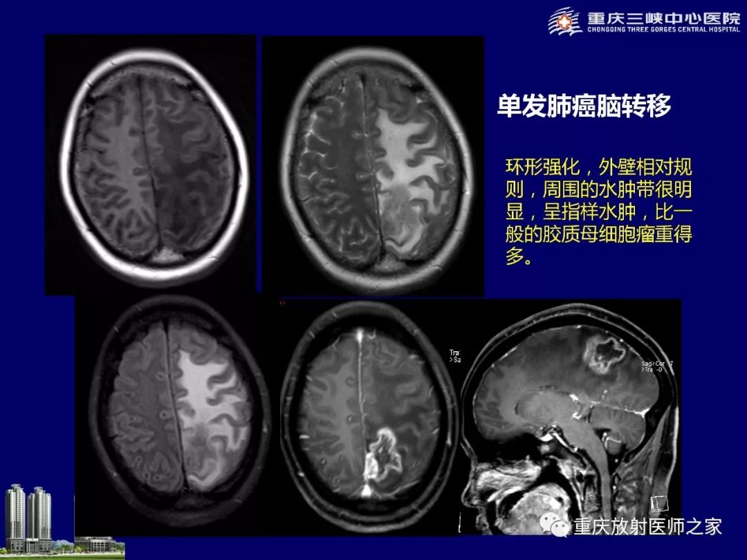影像PPT - 【PPT】脑内环形强化病变的影像诊断思路-28