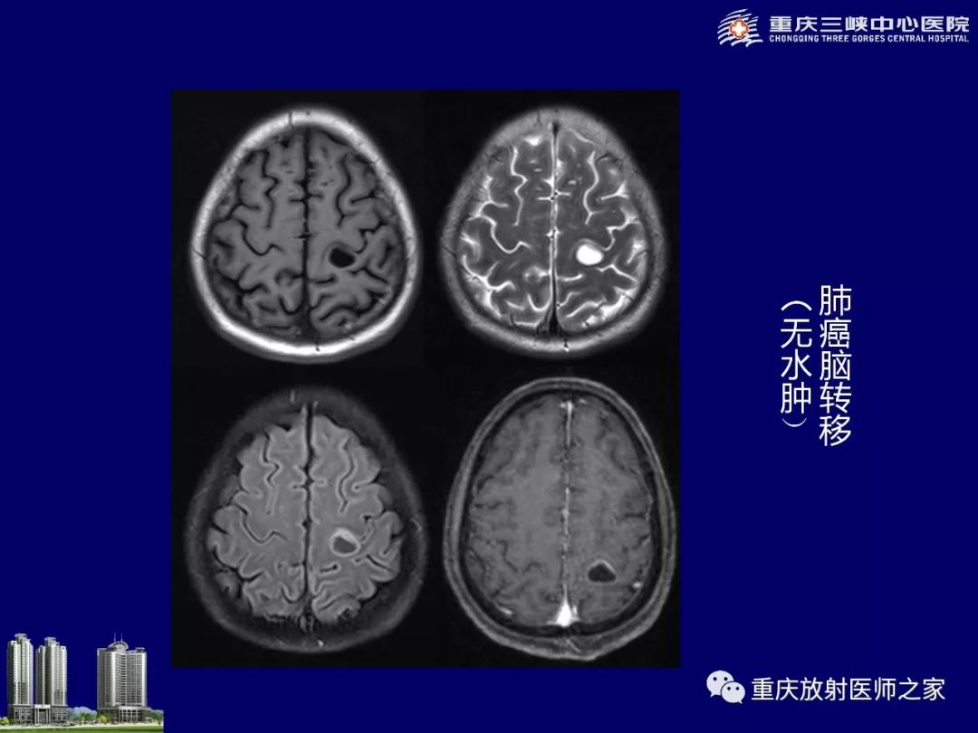 影像PPT - 【PPT】脑内环形强化病变的影像诊断思路-30