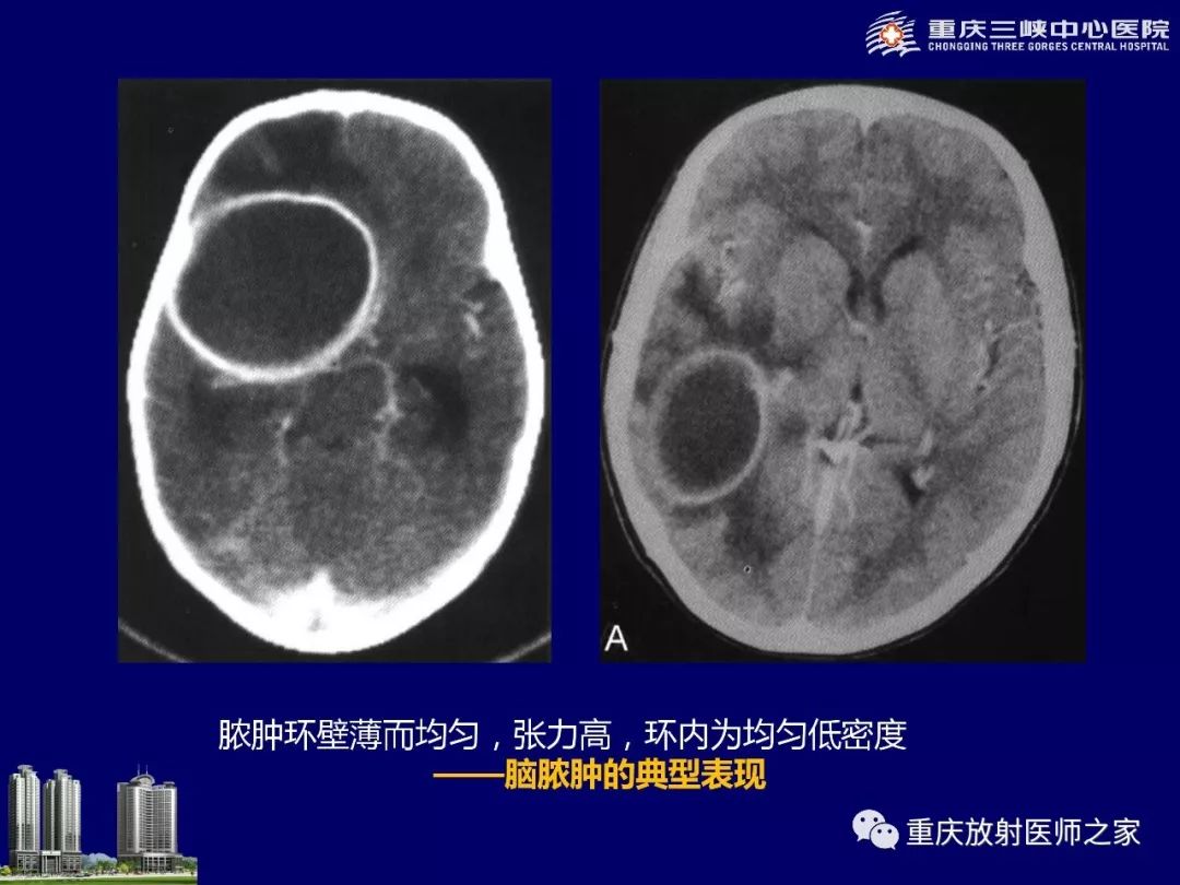 影像PPT - 【PPT】脑内环形强化病变的影像诊断思路-36