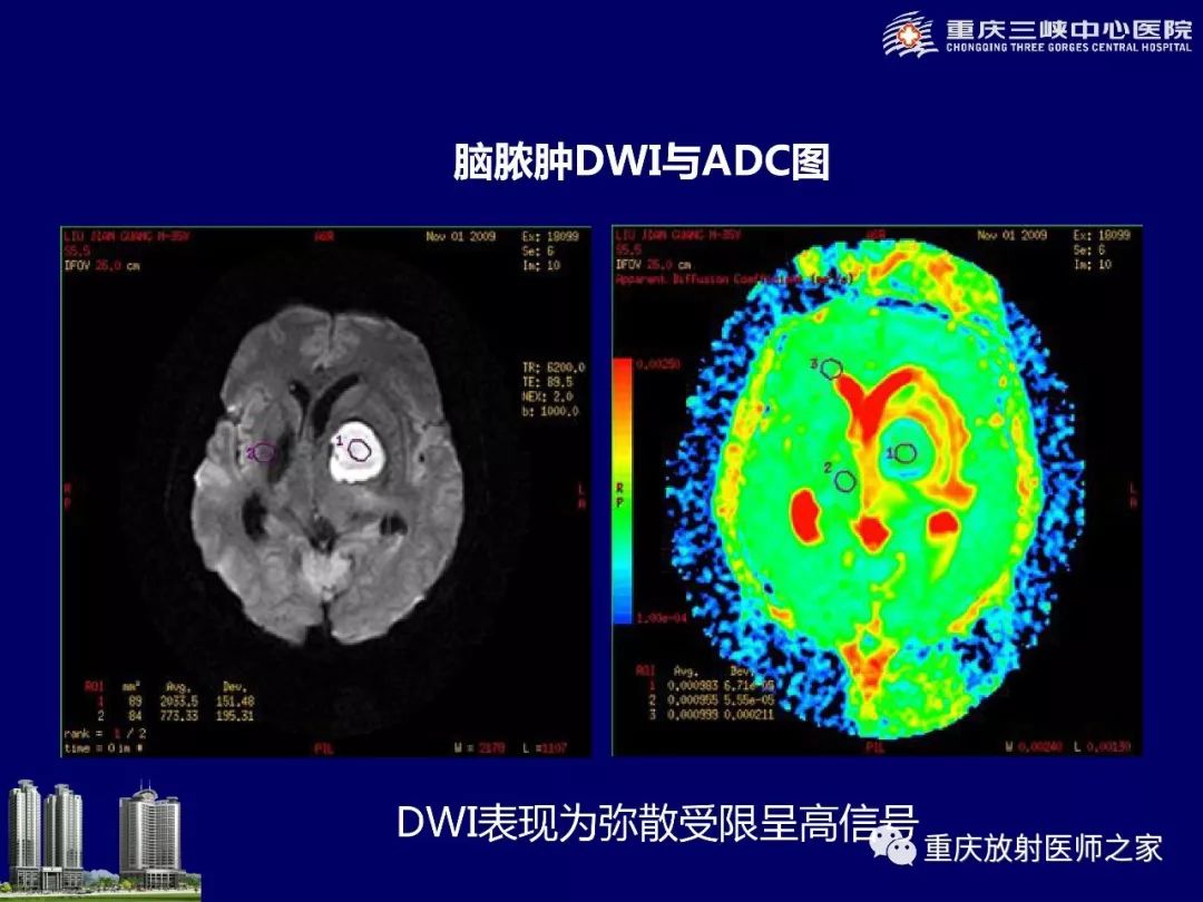 影像PPT - 【PPT】脑内环形强化病变的影像诊断思路-37
