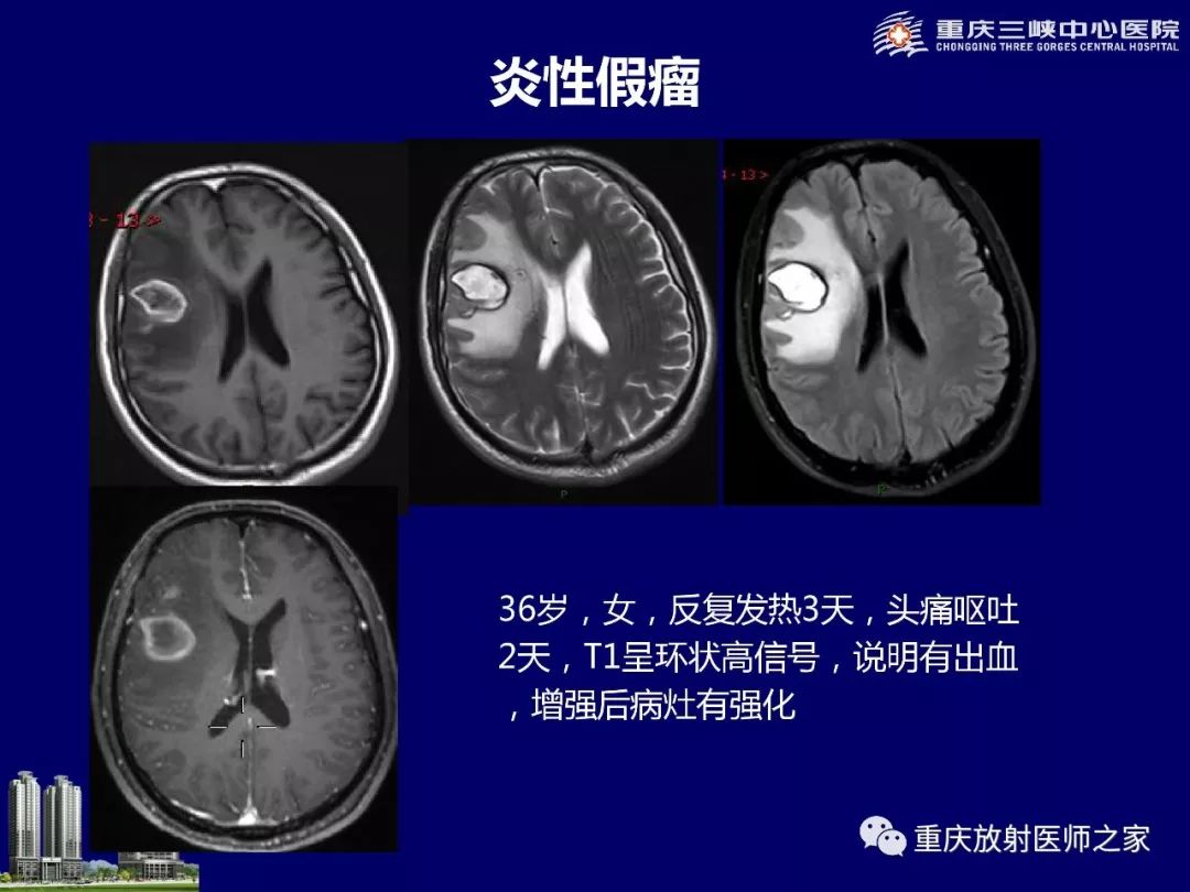 影像PPT - 【PPT】脑内环形强化病变的影像诊断思路-38