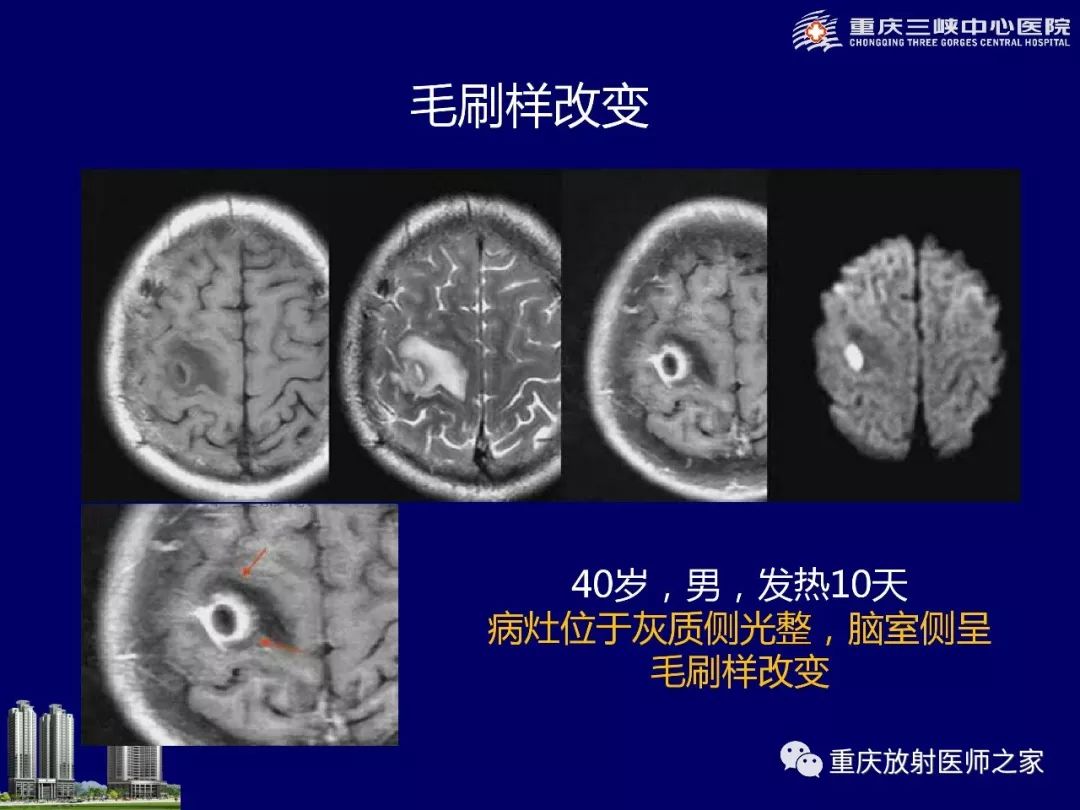 影像PPT - 【PPT】脑内环形强化病变的影像诊断思路-39