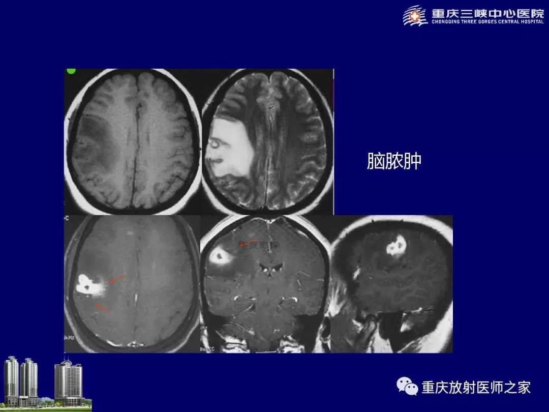 影像PPT - 【PPT】脑内环形强化病变的影像诊断思路-40