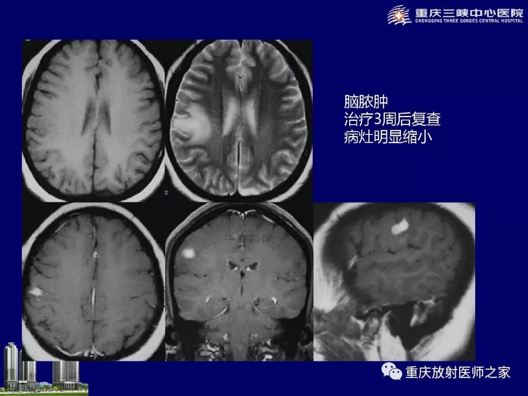 影像PPT - 【PPT】脑内环形强化病变的影像诊断思路-41