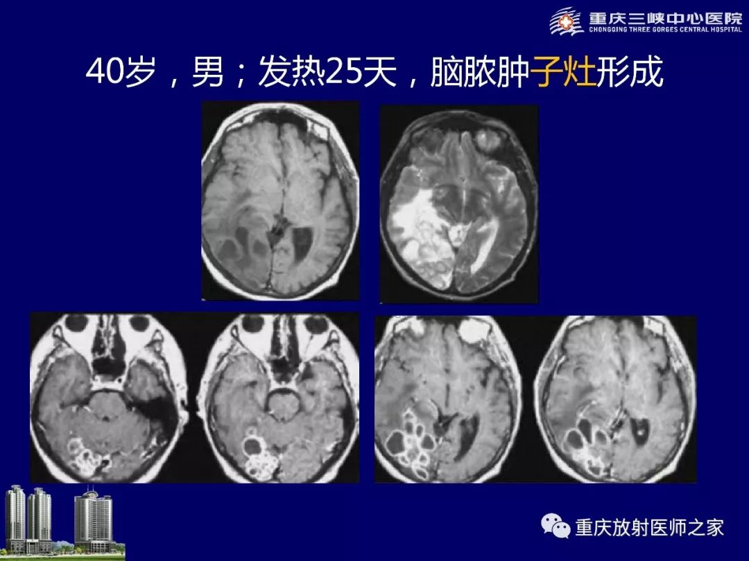 影像PPT - 【PPT】脑内环形强化病变的影像诊断思路-42