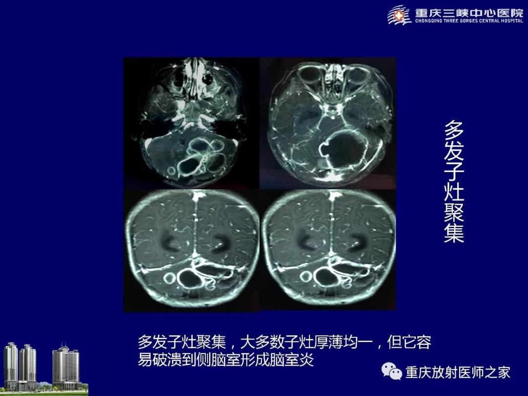 影像PPT - 【PPT】脑内环形强化病变的影像诊断思路-43