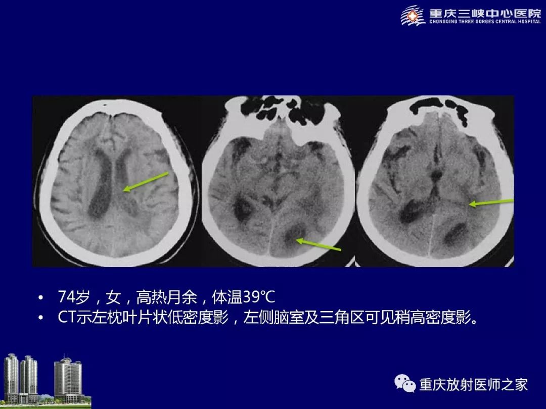 影像PPT - 【PPT】脑内环形强化病变的影像诊断思路-45