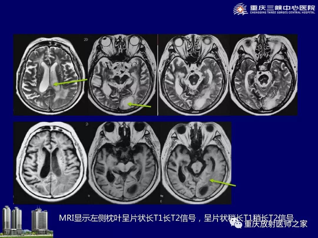 影像PPT - 【PPT】脑内环形强化病变的影像诊断思路-46