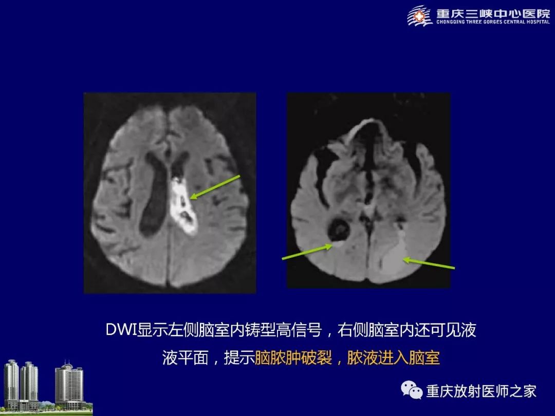 影像PPT - 【PPT】脑内环形强化病变的影像诊断思路-47