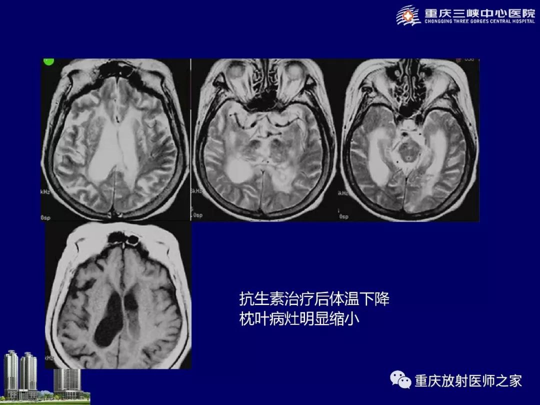 影像PPT - 【PPT】脑内环形强化病变的影像诊断思路-48