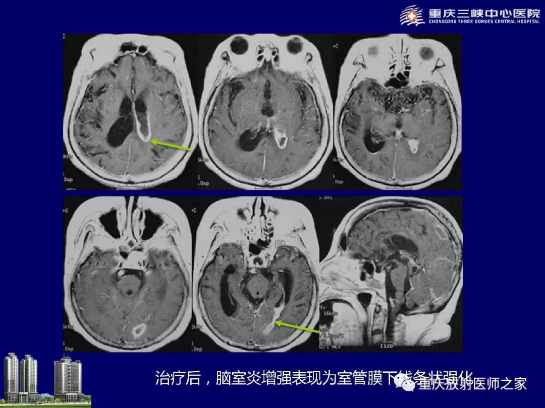 影像PPT - 【PPT】脑内环形强化病变的影像诊断思路-49