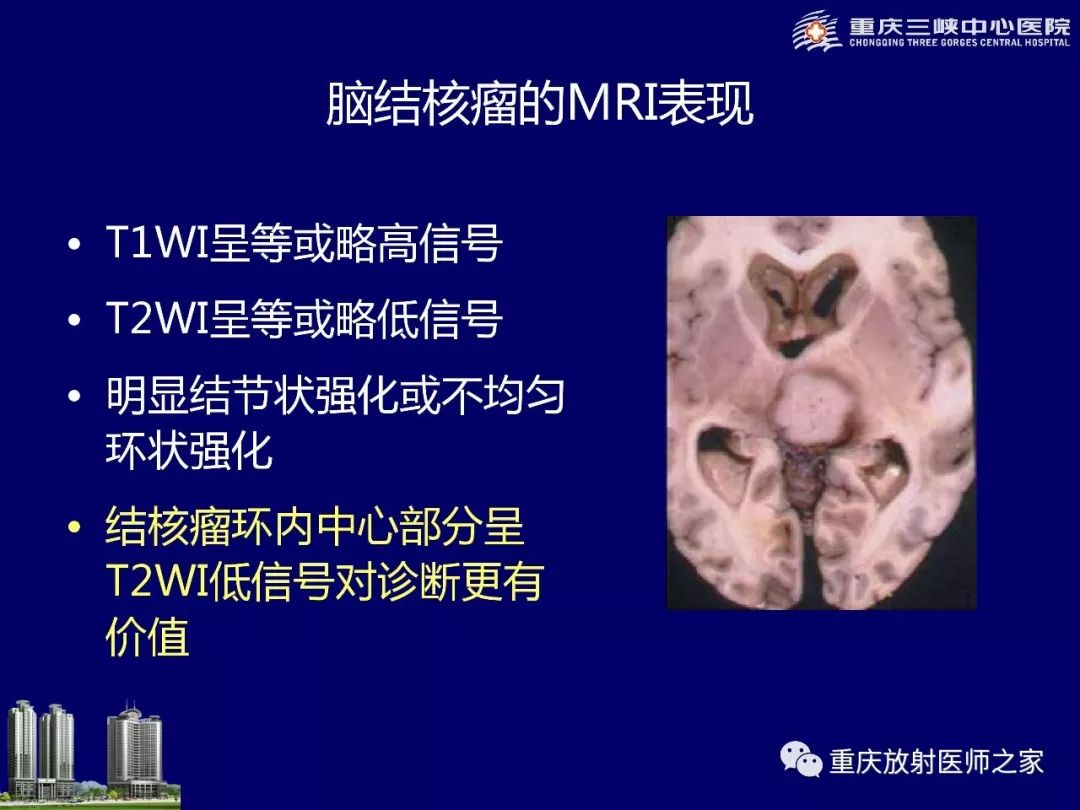 影像PPT - 【PPT】脑内环形强化病变的影像诊断思路-51