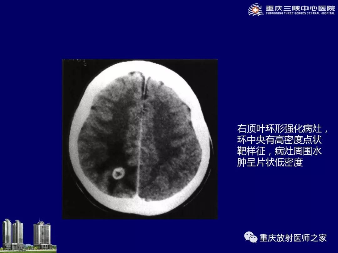 影像PPT - 【PPT】脑内环形强化病变的影像诊断思路-52