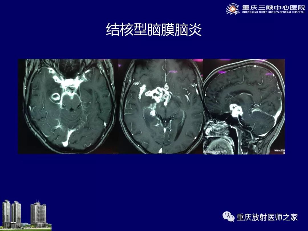 影像PPT - 【PPT】脑内环形强化病变的影像诊断思路-53