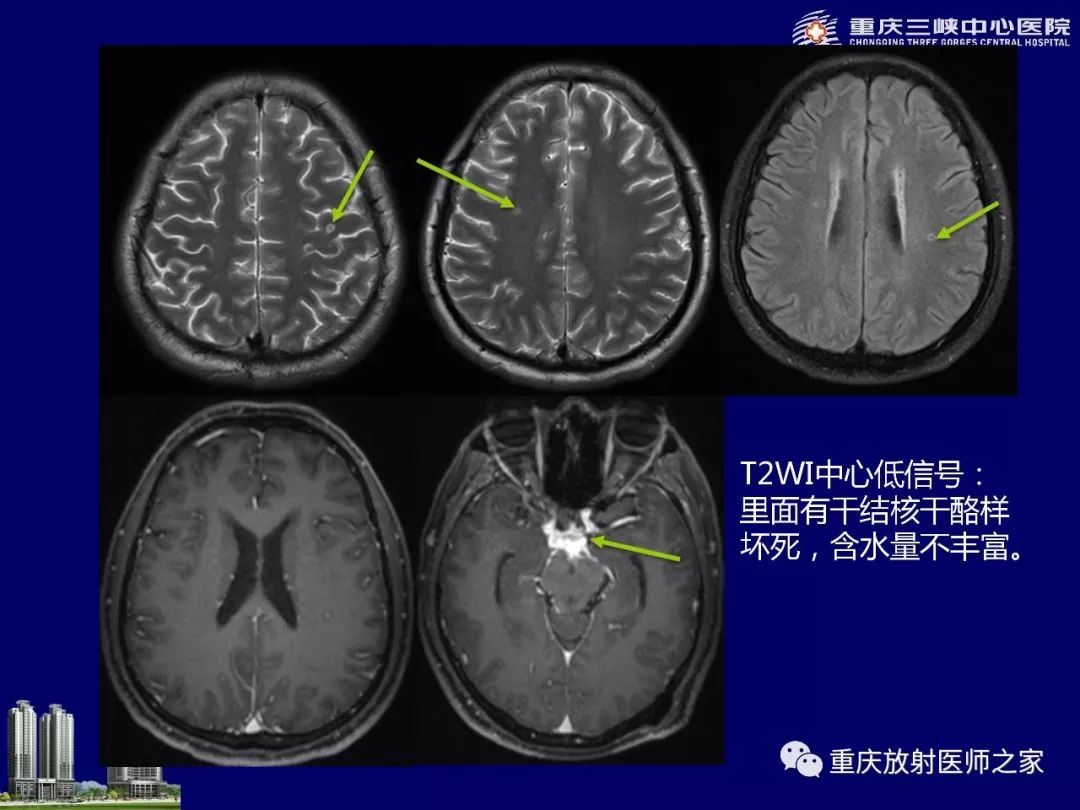 影像PPT - 【PPT】脑内环形强化病变的影像诊断思路-54
