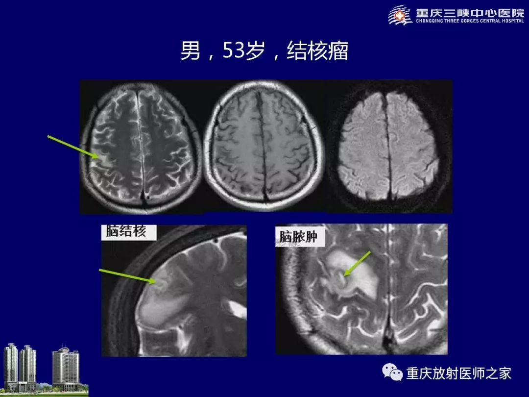 影像PPT - 【PPT】脑内环形强化病变的影像诊断思路-55
