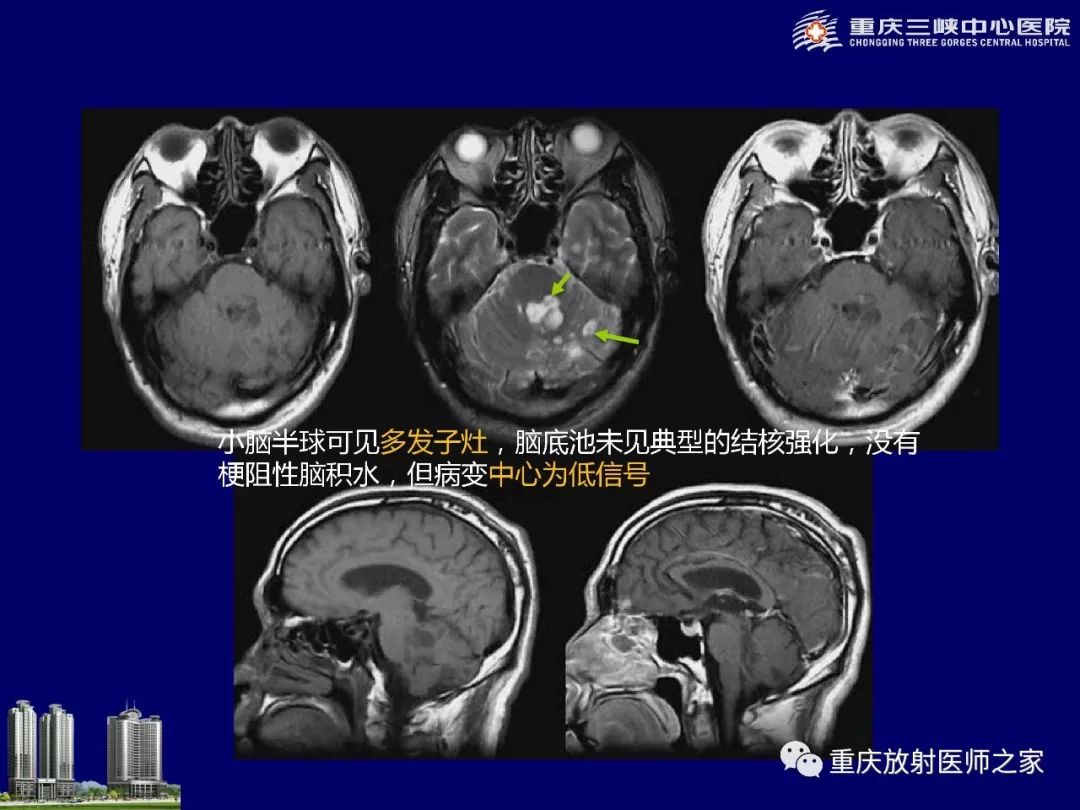 影像PPT - 【PPT】脑内环形强化病变的影像诊断思路-57