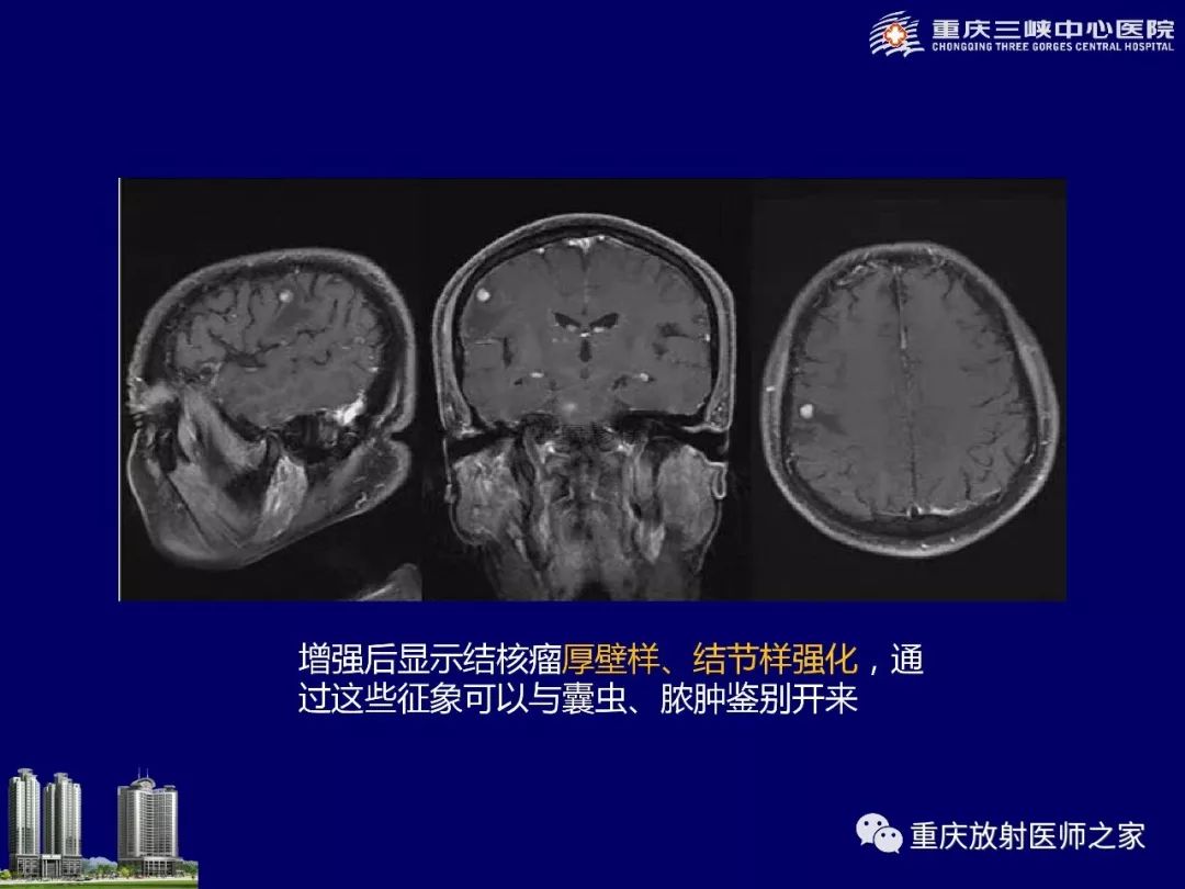 影像PPT - 【PPT】脑内环形强化病变的影像诊断思路-56