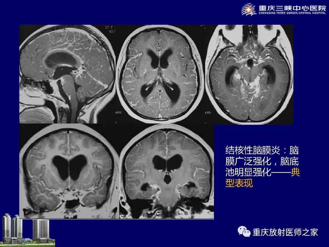 影像PPT - 【PPT】脑内环形强化病变的影像诊断思路-58