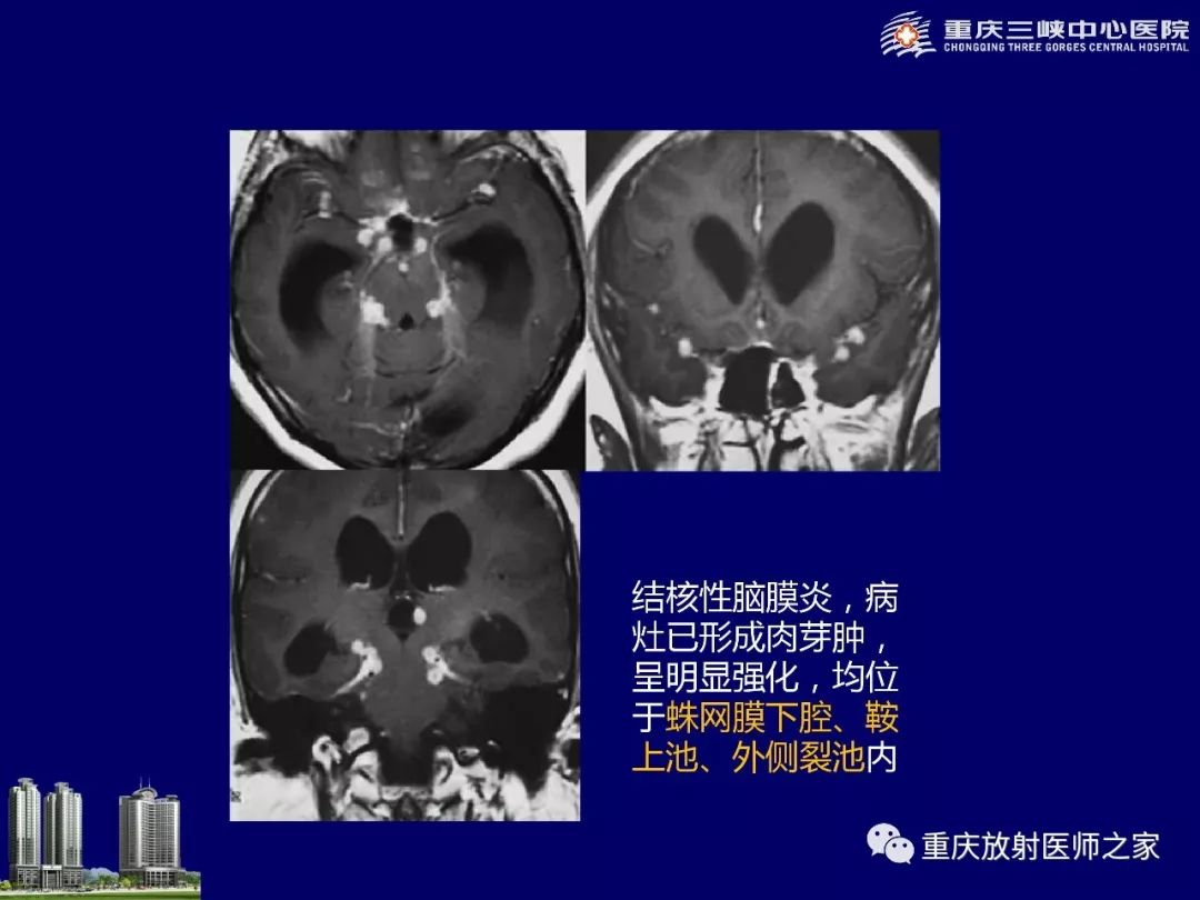 影像PPT - 【PPT】脑内环形强化病变的影像诊断思路-59