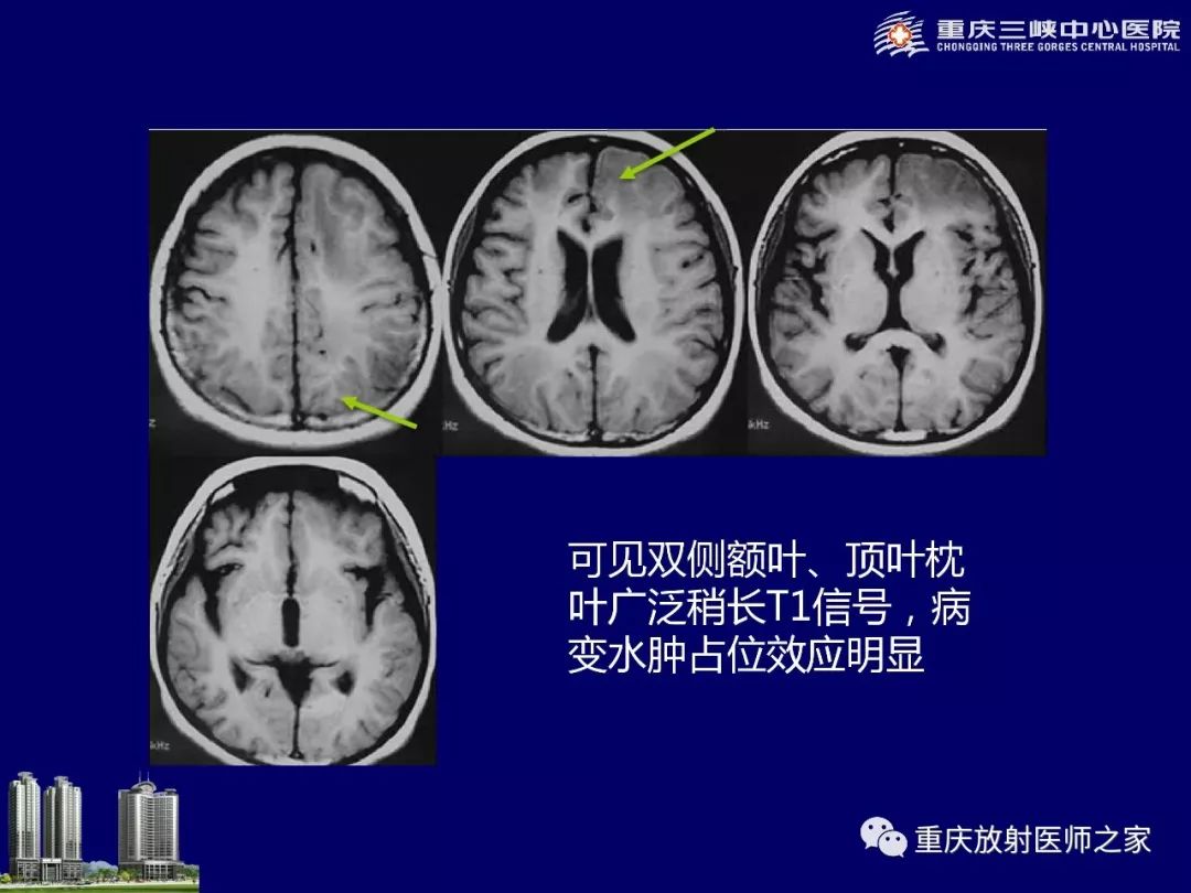 影像PPT - 【PPT】脑内环形强化病变的影像诊断思路-62