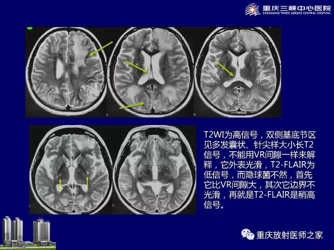 影像PPT - 【PPT】脑内环形强化病变的影像诊断思路-63