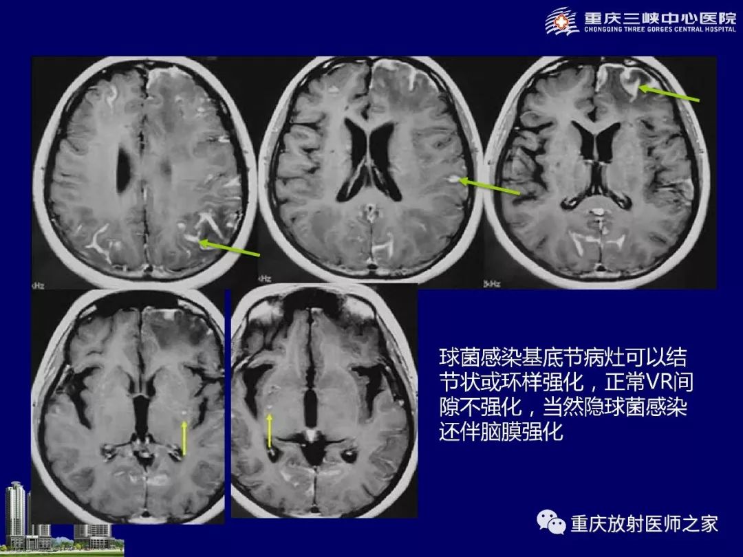 影像PPT - 【PPT】脑内环形强化病变的影像诊断思路-64